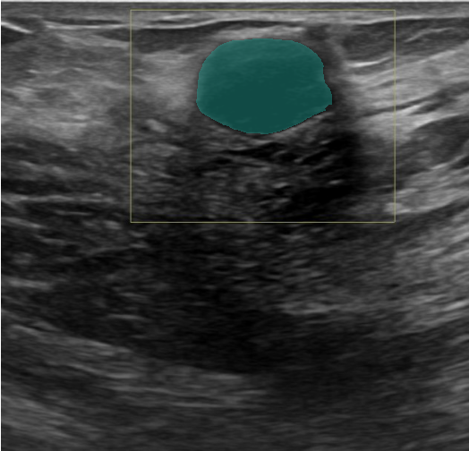 MedOtter breast mass segmentation on an ultrasound image