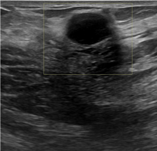 Breast mass raw scan