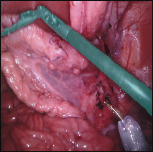 MedOtter surgical instrument segmentation on an endoscopy frame