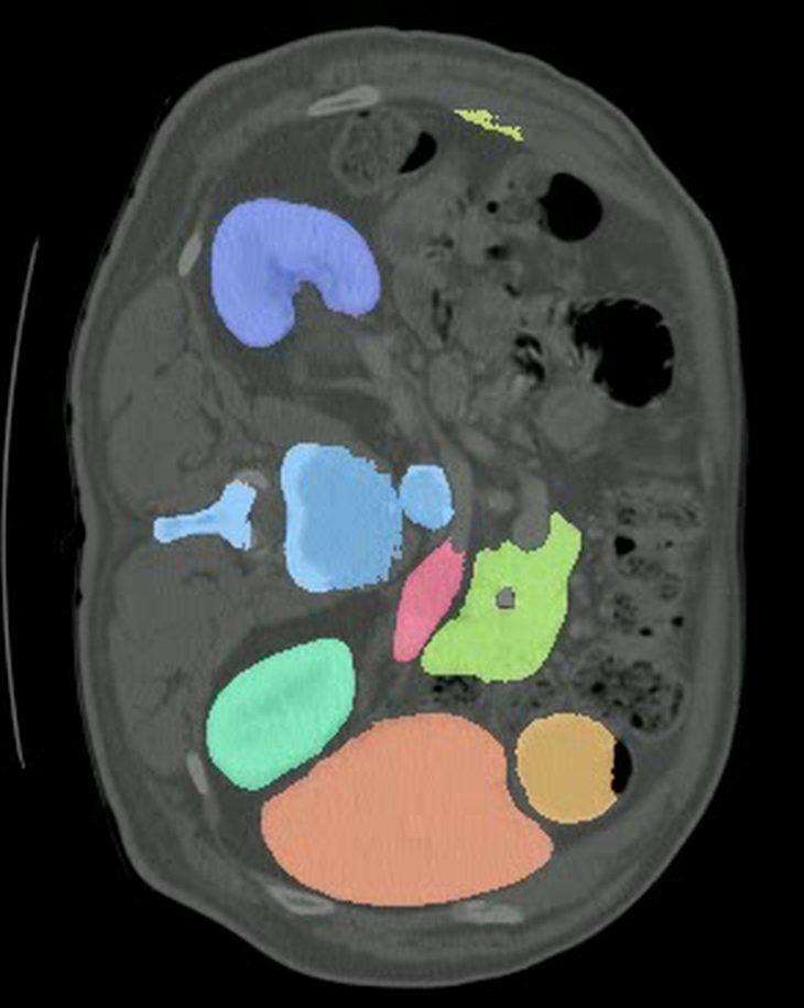 MedOtter multi-organ segmentation on an abdominal CT slice
