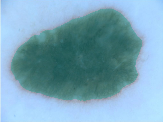 Skin lesion prediction overlay