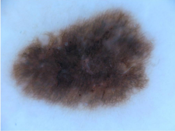 Skin lesion raw scan