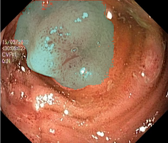 Polyp prediction overlay
