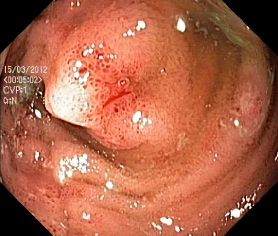 Polyp raw scan